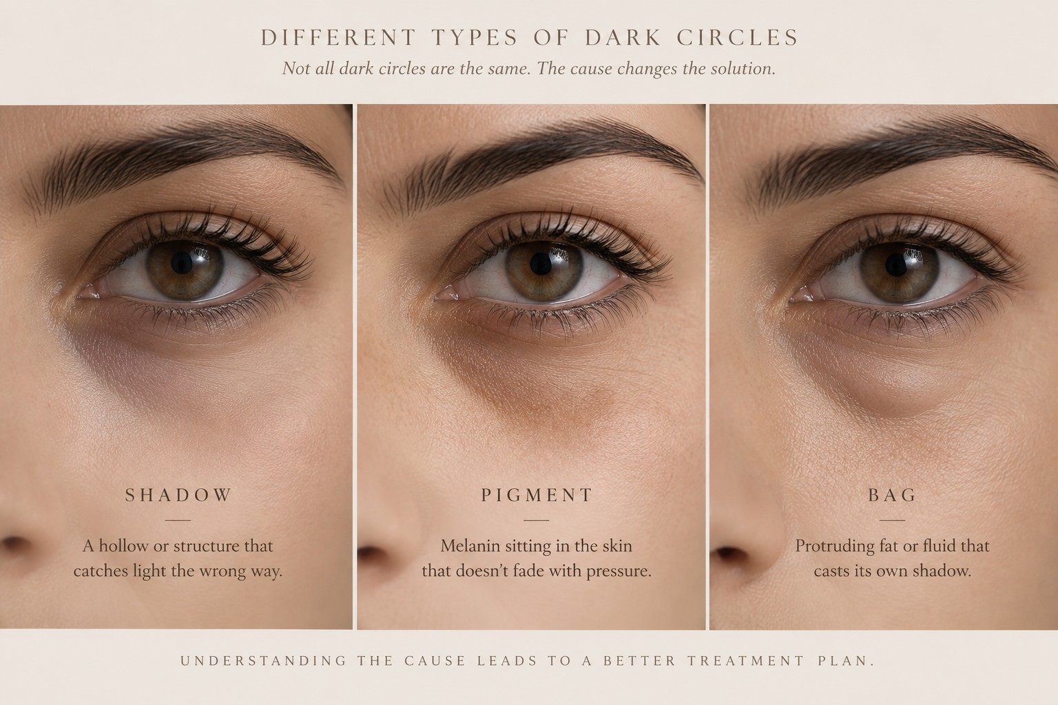 Three types of dark circles compared: shadow from a hollow, pigment in the skin, and a bag that casts its own shade